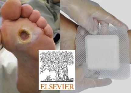 Development of advanced nanoparticle based scaffolds for the management of diabetic wounds